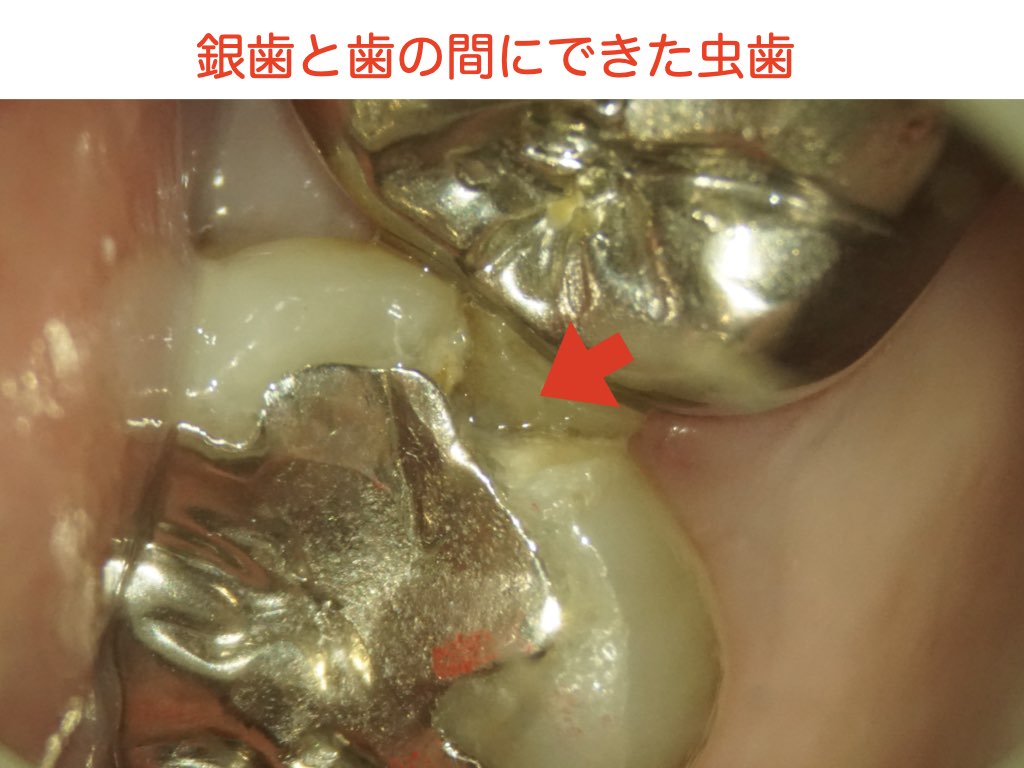 銀歯は虫歯になりやすい？🦷
