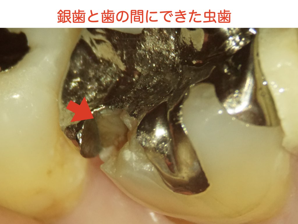 銀歯は虫歯になりやすい？🦷