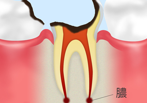 C4 歯根に達した虫歯